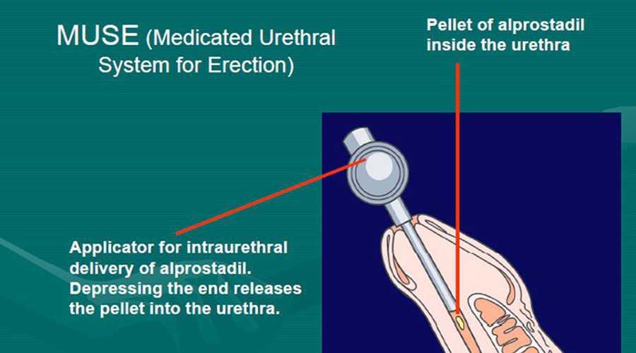 Doctors treat erectile dysfunction through intraurethral therapy